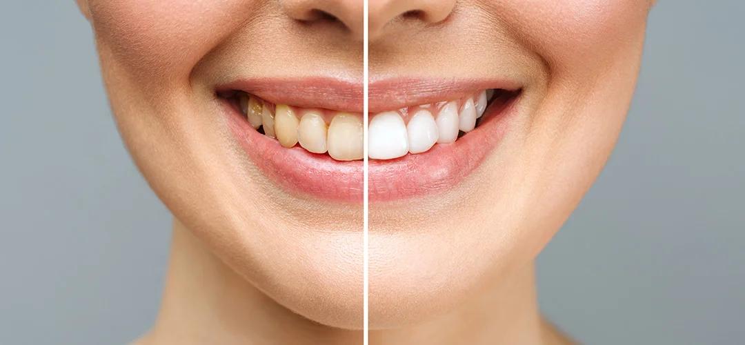 Crowns and bridges in lucknow, Best dentures in lucknow, Best maxillofacial surgeon in lucknow, Best dentist in Lucknow, dentist in Lucknow